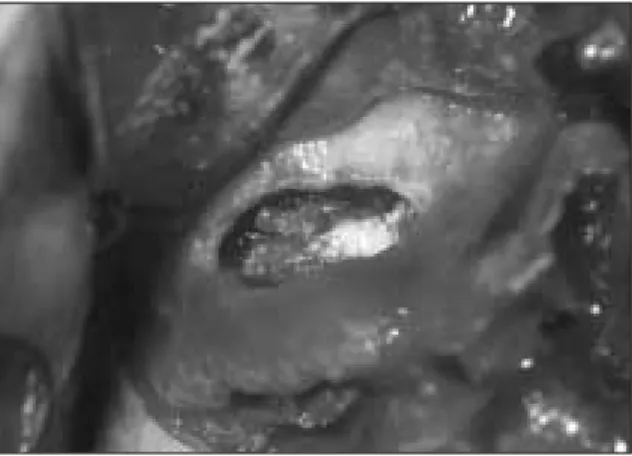 Fig. 1. Initial intraoral view. Fig. 2. Sinus bone graft.