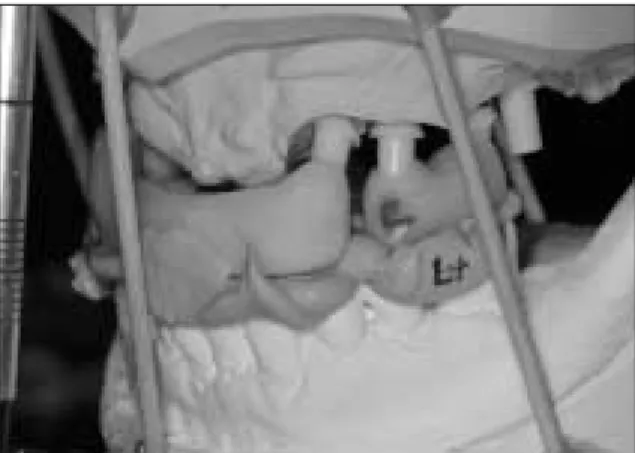Fig. 7. Intraoral view after second surgery. Fig. 8. Interocclusal  recording  for  fabrication  of  fixed prosthesis.