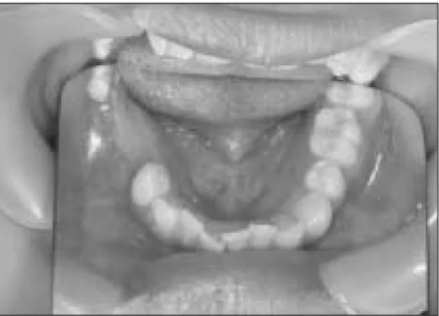 Fig. 10. Post-operative panoramic view showing the submerged state of Rt.