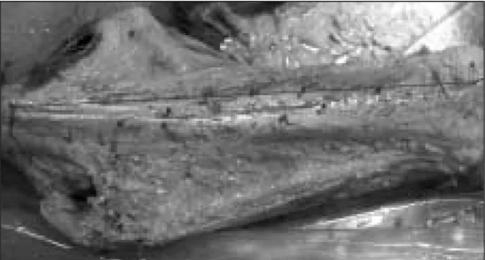 Fig. 2. Distribution of perforators(all perforators). Fig. 3. Distribution of perforators from descending branch.