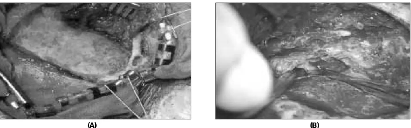 Fig. 4. Yellowish soft tumor mass difficult to identify tumor margin.