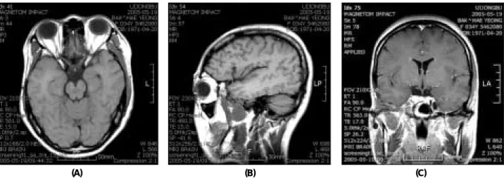 Fig. 5. MRI image at the 9 months after third operation. MRI views show almost complete regression of tumor mass.