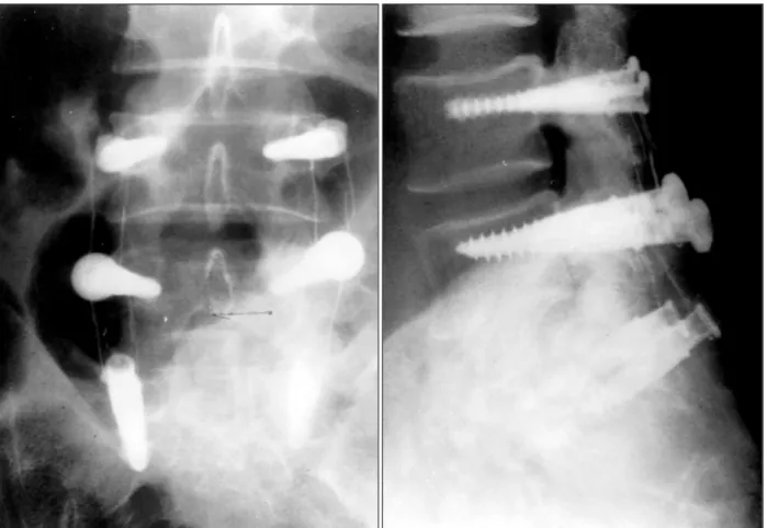 Fig. 2. Radiographs taken after insatallation of Graf fixation system. Plain Lumbar AP(left) and Lateral(right) films show screws 