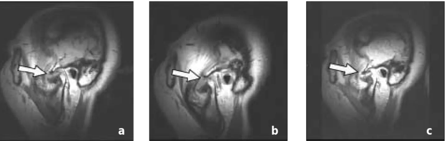 Fig. 3. Preoperative MRI. Disc is displaced anterior on closed mouth T1-weighted image (a) and it is reduced during mouth opening (b)