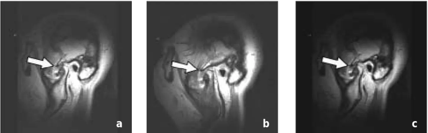 Fig. 5. Histopathological finding(HE stain, ×100) show- show-ing  chondrocyte(upper  arrow)  over  osteocyte(lower arrow).