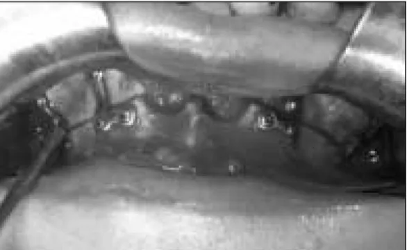Fig. 3. Intraoral photograph during operation of case 1