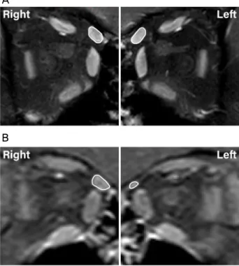 Figure 1. Orbital magnetic resonance imaging in planes at the 