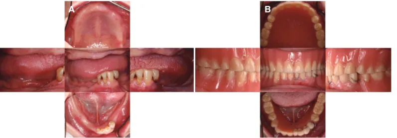 Fig. 1. Intraoral photo taking. (A)1st visit, (B) Provisionalization.