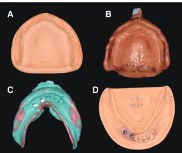 Fig. 2. Implant planning. (A) Frontal view, (B) Occlusal view, (C) Frontal view with implant axis, (D) Superimposition with temporary denture, (E, F) #41 area, (G) 