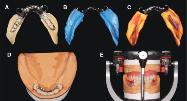 Fig. 7. Altered cast technique. (A) Tray with framework, (B) Border molding, (C) Final impression, (D) Altered cast, (E) Mounted on articulator.