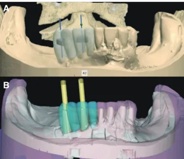 Fig. 9. Transfer crown design from implant planning to final prosthesis. (A) 