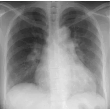 Fig. 3. Chest PA shows cardiomegaly with pulmonary hyper- hyper-tension.
