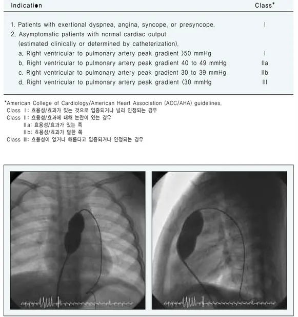 표 1. 단순 폐동맥 협착증의 치료 적응