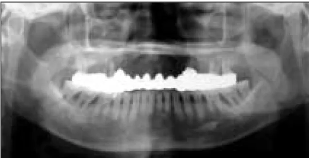 Fig. 1. Preoperative panoramic view of case 1.