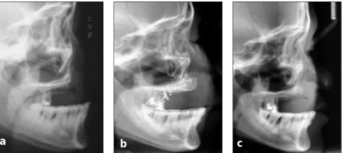 Fig. 6-a, b, c. Pre-, immediate Postoperative &amp; Post-op 6months cephalometric views of case 1.