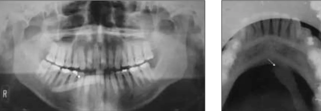 Fig. 3. A submandibular sialolith (arrow) perforates the right mouth floor.