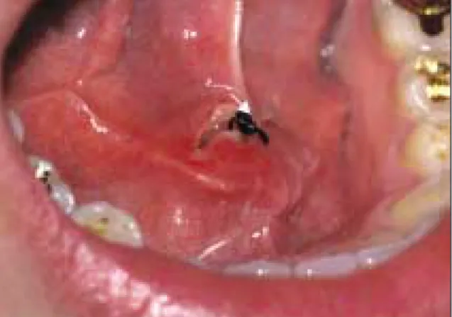 Fig. 7. Panoramic view after a sialolith removal.