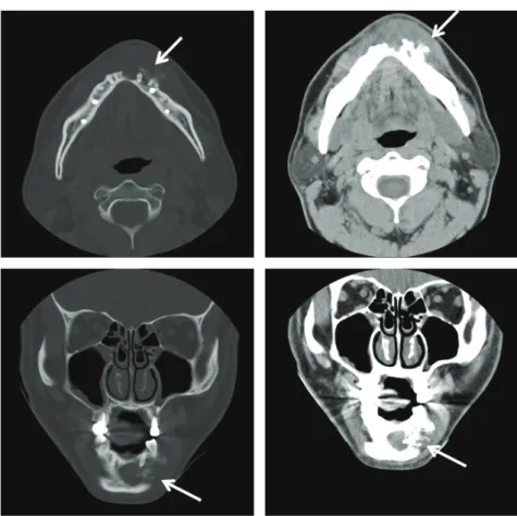 Fig.  2. Panoramic radiographic view shows ill‐defined bony destructive lesion ranging  from  the  left  body  to  right  body  of  mandible