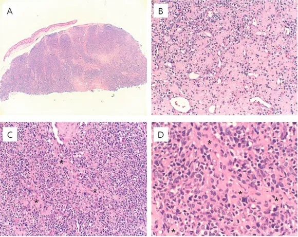 Fig.  4. Histologic findings of  incisional  biopsy  specimen.  A.  High  density  cellular  clusters  are  observed  beneath the oral epithelium