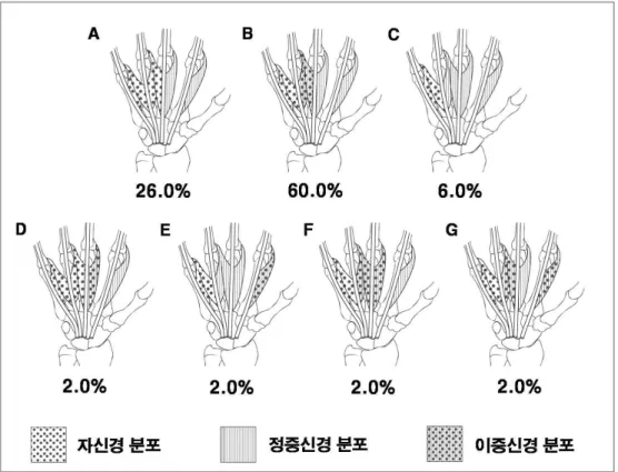 그림 2.한국 성인 50손에서 벌레근육의 신경분포 변이.A :둘째와 셋째 손가락 벌레 근에 정중신경이 분포하고 넷째와 다섯째 손가락 벌레근에 자신경이 분포하는 경우,B : 둘째와 셋째 손가락 벌레근에 정중신경이 분포하고,넷째 손가락 벌레근에 정중신경과 자신경의 이중신경분포를,다섯째 손가락 벌레근에 자신경이 분포하는 경우,C :둘째, 셋째,넷째 손가락 벌레근에 정중신경이 분포하고 다섯째 손가락 벌레근에 자신경이 분 포하는 경우,D :둘째 손가락 벌레근에 정