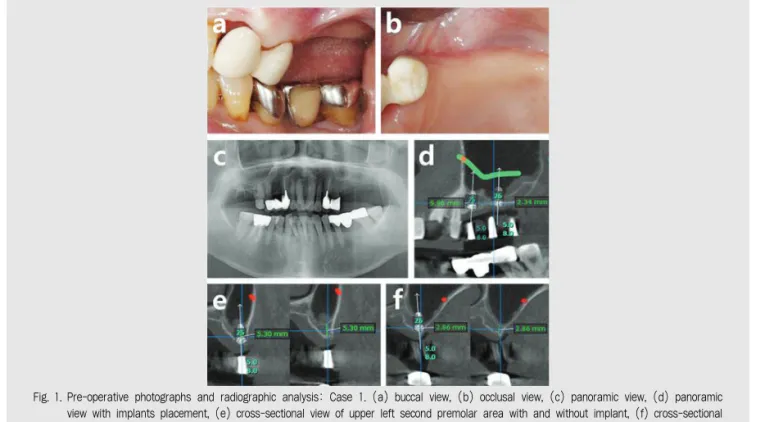 Fig. 1. Pre-operative photographs and radiographic analysis: Case 1. (a) buccal view, (b) occlusal view, (c) panoramic view, (d) panoramic view with implants placement, (e) cross-sectional view of upper left second premolar area with and without implant, (