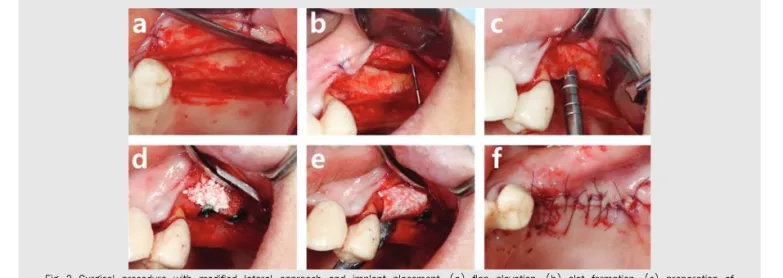 Fig. 2. Surgical  procedure  with  modified  lateral  approach  and  implant  placement