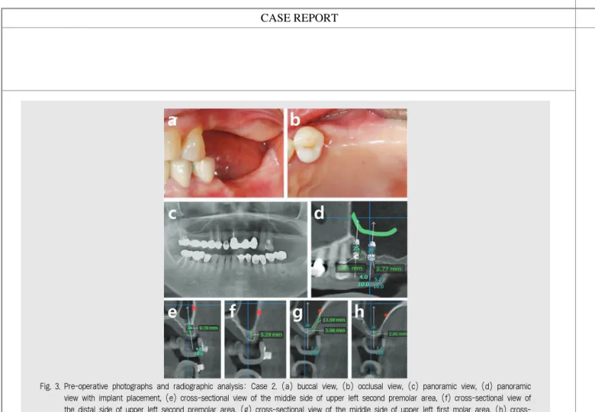 Fig. 3. Pre-operative photographs and radiographic analysis: Case 2. (a) buccal view, (b) occlusal view, (c) panoramic view, (d) panoramic view with implant placement, (e) cross-sectional view of the middle side of upper left second premolar area, (f) cros