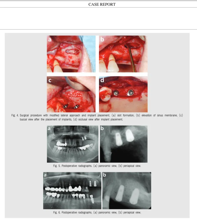 Fig. 4. Surgical  procedure  with  modified  lateral  approach  and  implant  placement