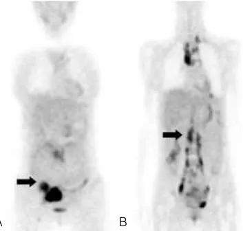 Fig. 1. PET scan showing increased metabolic activity (indicated by arrow) in adnexal mass (A) and multiple retroperitoneal lymph nodes from the level of T11 through L3 (B) in a patient with ovarian malignancy.