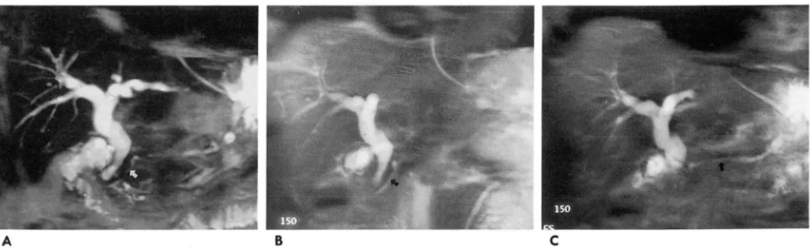 Fig.  2 .  A  65-year-old man  with  c holecyste cto my  state 