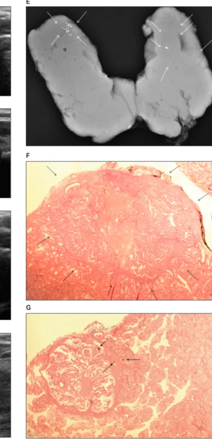 Figure 1.  Diffuse sclerosing variant of papillary thyroid carcinoma in a 39-year-old woman
