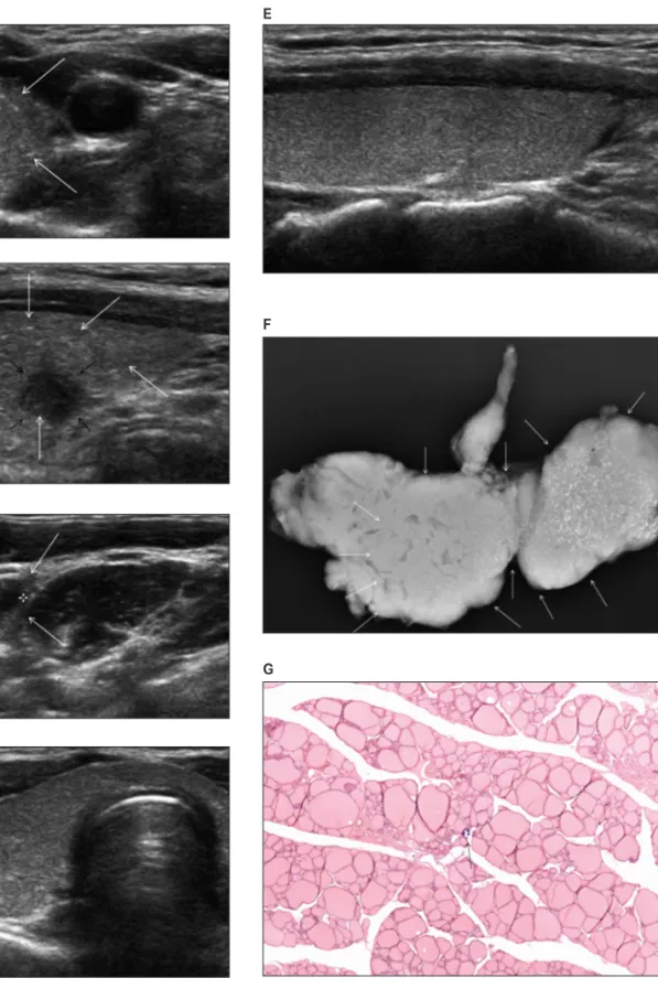Figure 2.  Diffuse sclerosing variant of papillary thyroid carcinoma in a 29-year-old woman