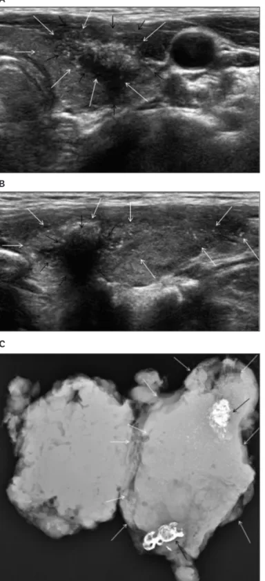 Figure 3.  Diffuse sclerosing variant of papillary thyroid carcinoma in