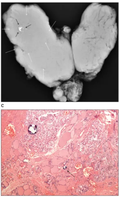 Figure 5.  Diffuse sclerosing variant of papillary thyroid carcinoma in a