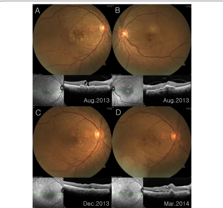 Figure 1 Color fundus photography and corresponding spectral-domain optical coherence tomography (OCT) scan through the fovea A Stage 3 full-thickness macular hole with large, soft, confluent macular drusen was noted in the right eye B The left eye fundus 