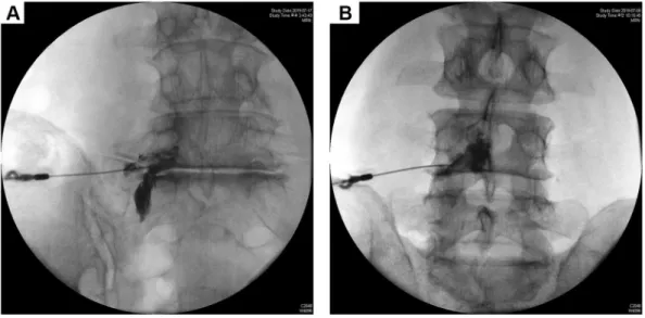 Figure 4  Flowchart  of  cases.  Regarding abnormal  patterns,  two  EF  cases  show  intradiscal  pattern;  of  the  three  LF  cases,  two  show  intradiscal  pattern  and  one  shows 