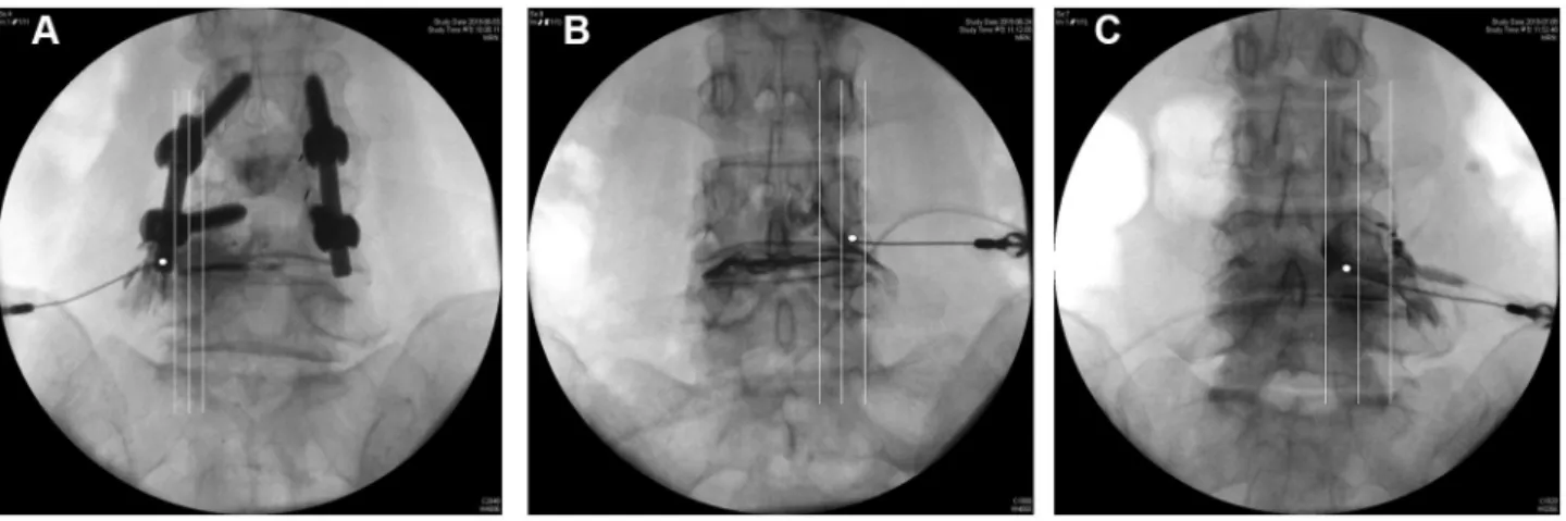 Table 4 Logistic Analysis for  Factors Associated with Contrast  Media Dispersion into the Epidural Space