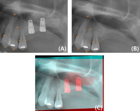 Figure 1. Process of image registration and mosaicing. (A), Registered radiograph taken 