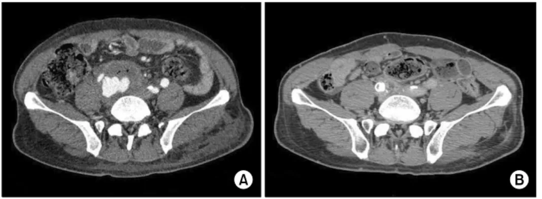 Fig. 1. (A) Preoperative CT scan,  mycotic aneurysm was enclosed by  abscess. (B) Postoperative CT scan  shows the resolved mycotic  aneur-ysm and abscess.