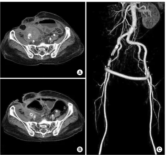 Fig. 2. (A) Preoperative CT scan,  mycotic aneurysm connected with  Rt. External iliac artery