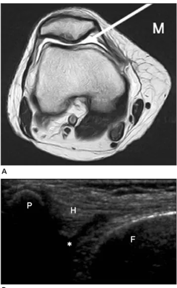 Figure 1. Axial T2-weighted MRI of the knee joint (A) and cor- cor-relative transverse sonogram (B)