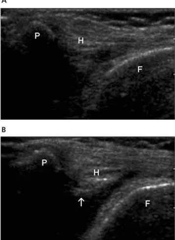 Figure 3. Before (A) and after (B) a sonographically guided injection. The fat pad is elevated upward because of the  inject-ed fluid