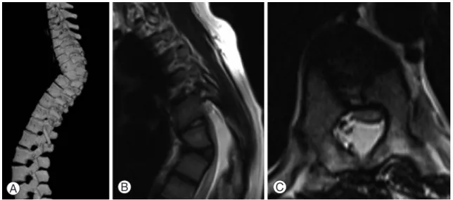 Fig. 1. Preoperaive computed tomography scan (A) showing 3D reconstrution of whole spine wherein kyphotic 