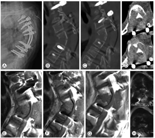 Fig. 3. Immediate postoperative radiograph (A) shows a T3 to T10 instrumented spine with short rods with in-