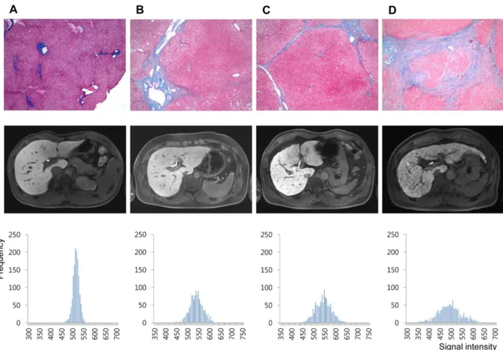 Figure 4. Representative cases of (A) 20 year old male (living-related healthy liver transplantation donor, F0), (B) 37 year old male (hepatocellular carcinoma, F2), (C) 57 year old male (hepatocellular carcinoma, F4), and (D) 54 year old male (hepatocellu