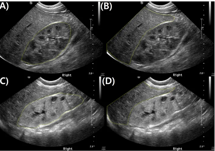 Fig 1. Longitudinal images of the right solitary kidneys with adjacent livers were captured in a 6-month-old female infant with an estimated glomerular filtration rate of 117.2 mL/min/1.73 m 2 (A), (B) and in a 7-month-old male infant with an estimated glo