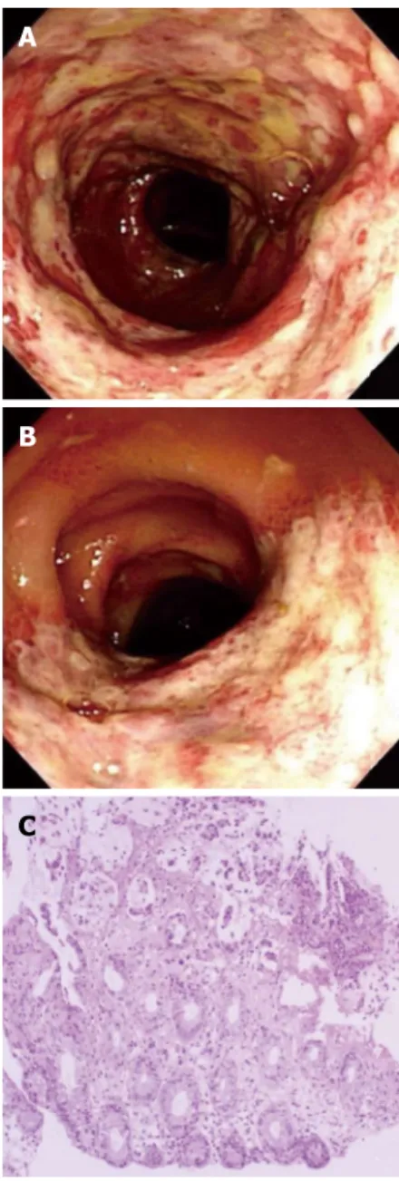 Figure 1  Colonoscopy images and pathology. A: Mucosal hyperemic 