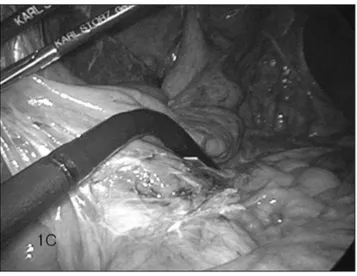 Figure 1. Case 1. A, Coronal plane portal venous phase CT shows an enlarged left para-aortic lymph node (long arrow)  infe-rior to the left renal vein (arrowhead) measuring 1.4 cm in  diam-eter with faint internal low density (short black arrow) suspicious