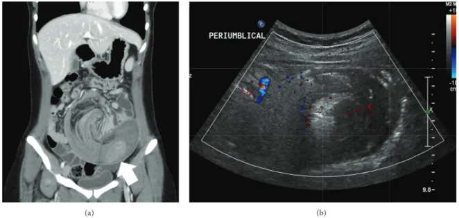 Figure 1: Abdominal pelvic computed tomography and ultrasonography. (a) Coronal view of the CT scan shows a long segment of jejunojejunal intussusception and polyps within the jejunum (white arrow)