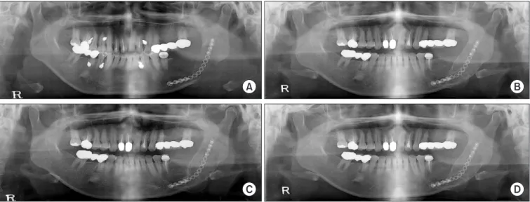 Fig. 2. Preoperative histological image shows woven bone and cemen-